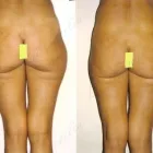 4 üzleti kép ZSÍRLESZÍVÁS KLINIKA DR LÁNYI CECÍLIA Plasztikai sebészet ban/ben Budapest