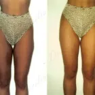 8 üzleti kép ZSÍRLESZÍVÁS KLINIKA DR LÁNYI CECÍLIA Plasztikai sebészet ban/ben Budapest