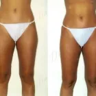 37 üzleti kép ZSÍRLESZÍVÁS KLINIKA DR LÁNYI CECÍLIA Plasztikai sebészet ban/ben Budapest