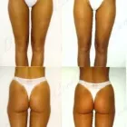 38 üzleti kép ZSÍRLESZÍVÁS KLINIKA DR LÁNYI CECÍLIA Plasztikai sebészet ban/ben Budapest