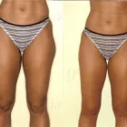 49 üzleti kép ZSÍRLESZÍVÁS KLINIKA DR LÁNYI CECÍLIA Plasztikai sebészet ban/ben Budapest