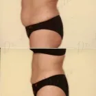 50 üzleti kép ZSÍRLESZÍVÁS KLINIKA DR LÁNYI CECÍLIA Plasztikai sebészet ban/ben Budapest