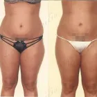 52 üzleti kép ZSÍRLESZÍVÁS KLINIKA DR LÁNYI CECÍLIA Plasztikai sebészet ban/ben Budapest