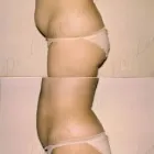 54 üzleti kép ZSÍRLESZÍVÁS KLINIKA DR LÁNYI CECÍLIA Plasztikai sebészet ban/ben Budapest