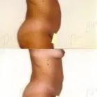 55 üzleti kép ZSÍRLESZÍVÁS KLINIKA DR LÁNYI CECÍLIA Plasztikai sebészet ban/ben Budapest