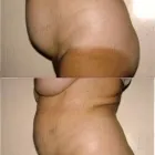 56 üzleti kép ZSÍRLESZÍVÁS KLINIKA DR LÁNYI CECÍLIA Plasztikai sebészet ban/ben Budapest