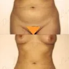 57 üzleti kép ZSÍRLESZÍVÁS KLINIKA DR LÁNYI CECÍLIA Plasztikai sebészet ban/ben Budapest