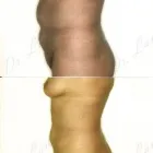 60 üzleti kép ZSÍRLESZÍVÁS KLINIKA DR LÁNYI CECÍLIA Plasztikai sebészet ban/ben Budapest