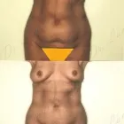 62 üzleti kép ZSÍRLESZÍVÁS KLINIKA DR LÁNYI CECÍLIA Plasztikai sebészet ban/ben Budapest