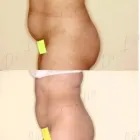 64 üzleti kép ZSÍRLESZÍVÁS KLINIKA DR LÁNYI CECÍLIA Plasztikai sebészet ban/ben Budapest