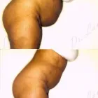 65 üzleti kép ZSÍRLESZÍVÁS KLINIKA DR LÁNYI CECÍLIA Plasztikai sebészet ban/ben Budapest