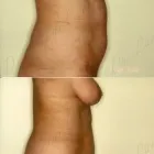 66 üzleti kép ZSÍRLESZÍVÁS KLINIKA DR LÁNYI CECÍLIA Plasztikai sebészet ban/ben Budapest