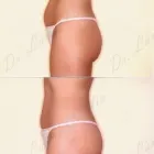 72 üzleti kép ZSÍRLESZÍVÁS KLINIKA DR LÁNYI CECÍLIA Plasztikai sebészet ban/ben Budapest