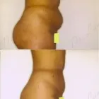 78 üzleti kép ZSÍRLESZÍVÁS KLINIKA DR LÁNYI CECÍLIA Plasztikai sebészet ban/ben Budapest