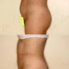 79 üzleti kép ZSÍRLESZÍVÁS KLINIKA DR LÁNYI CECÍLIA Plasztikai sebészet ban/ben Budapest