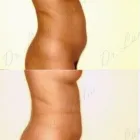 80 üzleti kép ZSÍRLESZÍVÁS KLINIKA DR LÁNYI CECÍLIA Plasztikai sebészet ban/ben Budapest