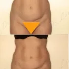 81 üzleti kép ZSÍRLESZÍVÁS KLINIKA DR LÁNYI CECÍLIA Plasztikai sebészet ban/ben Budapest