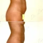 83 üzleti kép ZSÍRLESZÍVÁS KLINIKA DR LÁNYI CECÍLIA Plasztikai sebészet ban/ben Budapest