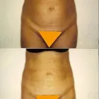 84 üzleti kép ZSÍRLESZÍVÁS KLINIKA DR LÁNYI CECÍLIA Plasztikai sebészet ban/ben Budapest