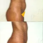 85 üzleti kép ZSÍRLESZÍVÁS KLINIKA DR LÁNYI CECÍLIA Plasztikai sebészet ban/ben Budapest