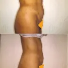 87 üzleti kép ZSÍRLESZÍVÁS KLINIKA DR LÁNYI CECÍLIA Plasztikai sebészet ban/ben Budapest