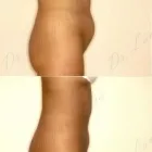 89 üzleti kép ZSÍRLESZÍVÁS KLINIKA DR LÁNYI CECÍLIA Plasztikai sebészet ban/ben Budapest