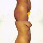 91 üzleti kép ZSÍRLESZÍVÁS KLINIKA DR LÁNYI CECÍLIA Plasztikai sebészet ban/ben Budapest