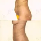 93 üzleti kép ZSÍRLESZÍVÁS KLINIKA DR LÁNYI CECÍLIA Plasztikai sebészet ban/ben Budapest