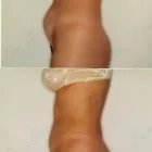 101 üzleti kép ZSÍRLESZÍVÁS KLINIKA DR LÁNYI CECÍLIA Plasztikai sebészet ban/ben Budapest