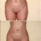 105 üzleti kép ZSÍRLESZÍVÁS KLINIKA DR LÁNYI CECÍLIA Plasztikai sebészet ban/ben Budapest