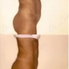 108 üzleti kép ZSÍRLESZÍVÁS KLINIKA DR LÁNYI CECÍLIA Plasztikai sebészet ban/ben Budapest