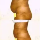 109 üzleti kép ZSÍRLESZÍVÁS KLINIKA DR LÁNYI CECÍLIA Plasztikai sebészet ban/ben Budapest