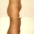 110 üzleti kép ZSÍRLESZÍVÁS KLINIKA DR LÁNYI CECÍLIA Plasztikai sebészet ban/ben Budapest