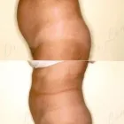 112 üzleti kép ZSÍRLESZÍVÁS KLINIKA DR LÁNYI CECÍLIA Plasztikai sebészet ban/ben Budapest