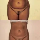 115 üzleti kép ZSÍRLESZÍVÁS KLINIKA DR LÁNYI CECÍLIA Plasztikai sebészet ban/ben Budapest