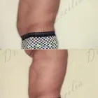 116 üzleti kép ZSÍRLESZÍVÁS KLINIKA DR LÁNYI CECÍLIA Plasztikai sebészet ban/ben Budapest