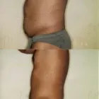 118 üzleti kép ZSÍRLESZÍVÁS KLINIKA DR LÁNYI CECÍLIA Plasztikai sebészet ban/ben Budapest