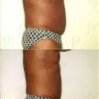 120 üzleti kép ZSÍRLESZÍVÁS KLINIKA DR LÁNYI CECÍLIA Plasztikai sebészet ban/ben Budapest