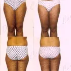 125 üzleti kép ZSÍRLESZÍVÁS KLINIKA DR LÁNYI CECÍLIA Plasztikai sebészet ban/ben Budapest