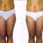 126 üzleti kép ZSÍRLESZÍVÁS KLINIKA DR LÁNYI CECÍLIA Plasztikai sebészet ban/ben Budapest