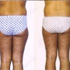 127 üzleti kép ZSÍRLESZÍVÁS KLINIKA DR LÁNYI CECÍLIA Plasztikai sebészet ban/ben Budapest