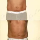 130 üzleti kép ZSÍRLESZÍVÁS KLINIKA DR LÁNYI CECÍLIA Plasztikai sebészet ban/ben Budapest