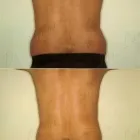 140 üzleti kép ZSÍRLESZÍVÁS KLINIKA DR LÁNYI CECÍLIA Plasztikai sebészet ban/ben Budapest