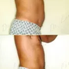 154 üzleti kép ZSÍRLESZÍVÁS KLINIKA DR LÁNYI CECÍLIA Plasztikai sebészet ban/ben Budapest