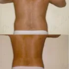 156 üzleti kép ZSÍRLESZÍVÁS KLINIKA DR LÁNYI CECÍLIA Plasztikai sebészet ban/ben Budapest