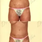 166 üzleti kép ZSÍRLESZÍVÁS KLINIKA DR LÁNYI CECÍLIA Plasztikai sebészet ban/ben Budapest