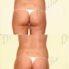 168 üzleti kép ZSÍRLESZÍVÁS KLINIKA DR LÁNYI CECÍLIA Plasztikai sebészet ban/ben Budapest