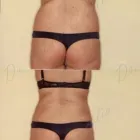 170 üzleti kép ZSÍRLESZÍVÁS KLINIKA DR LÁNYI CECÍLIA Plasztikai sebészet ban/ben Budapest