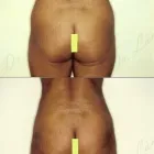 171 üzleti kép ZSÍRLESZÍVÁS KLINIKA DR LÁNYI CECÍLIA Plasztikai sebészet ban/ben Budapest