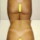 172 üzleti kép ZSÍRLESZÍVÁS KLINIKA DR LÁNYI CECÍLIA Plasztikai sebészet ban/ben Budapest